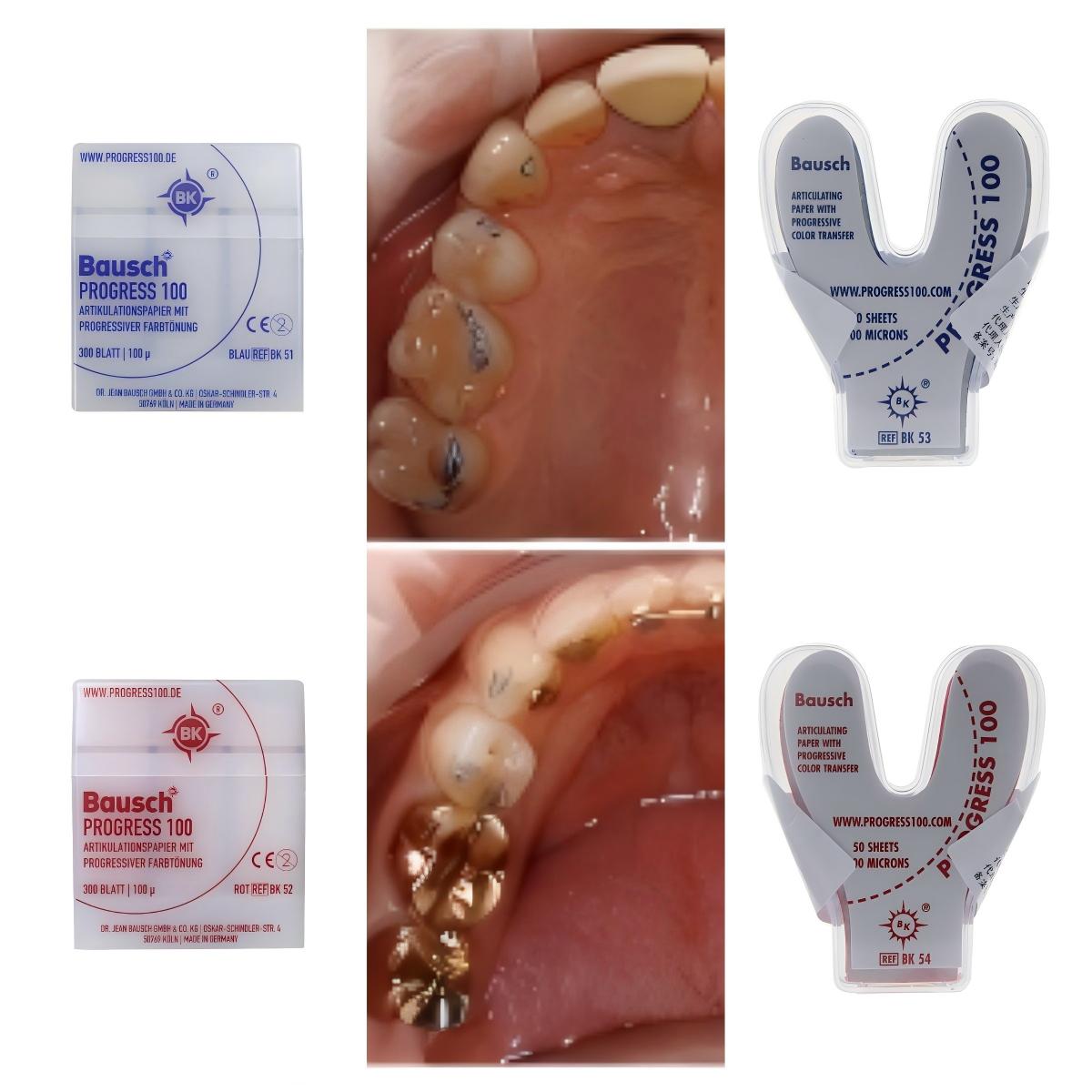 Bausch BK51 BK52 BK53 BK54 Diş - Bite Indicator incelemesi ve fiyatı